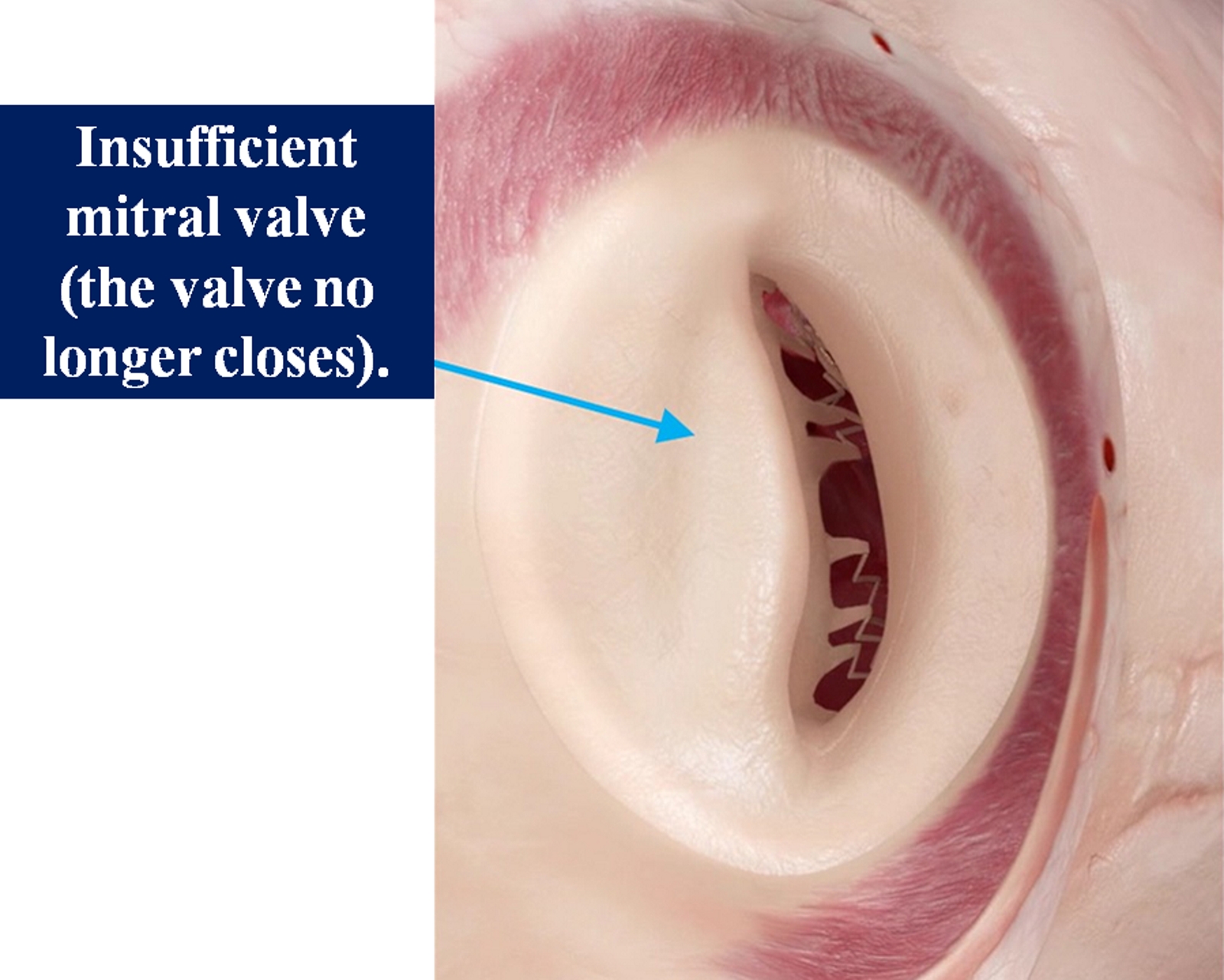 Insufficient mitral valve (the valve no longer closes).