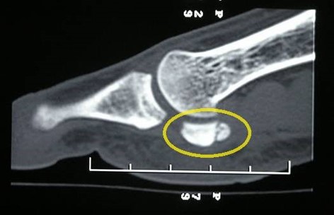 CT scan showing a sesamoid stress fracture.