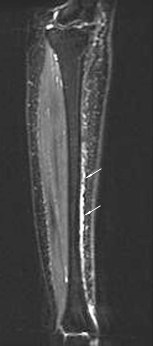 MRI image of a grade 1 stress fracture
Stress fracture lecture given by several US military sports medicine physicians