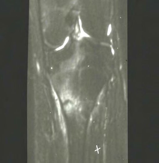 MRI image showing a grade 4 stress fracture