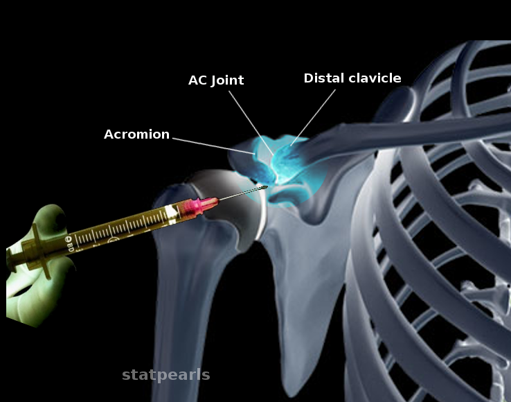 AC joint injection