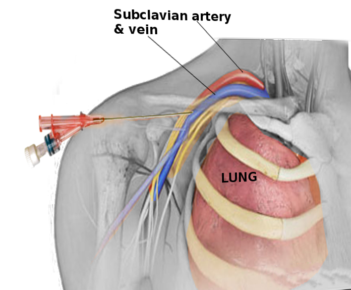 Subclavian vein access