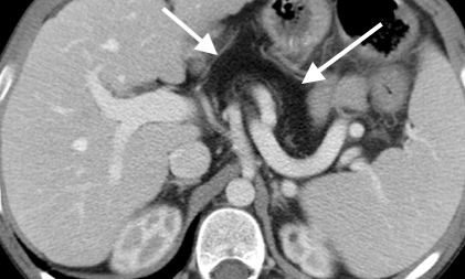 Fatty replacement of pancreas seen by CT.