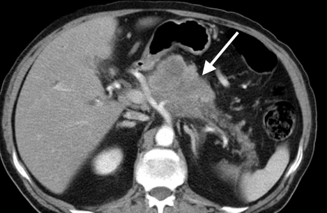 Pancreatic adenocarcinoma via CT. 