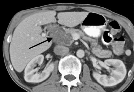 Serous cystadenoma as seen by CT.