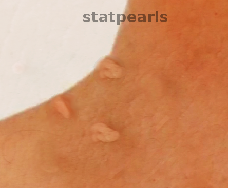 Skin tags on the neck