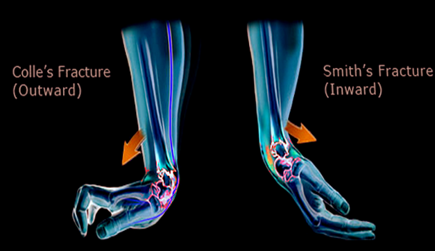 <p>Colles Fracture Versus Smith Fracture