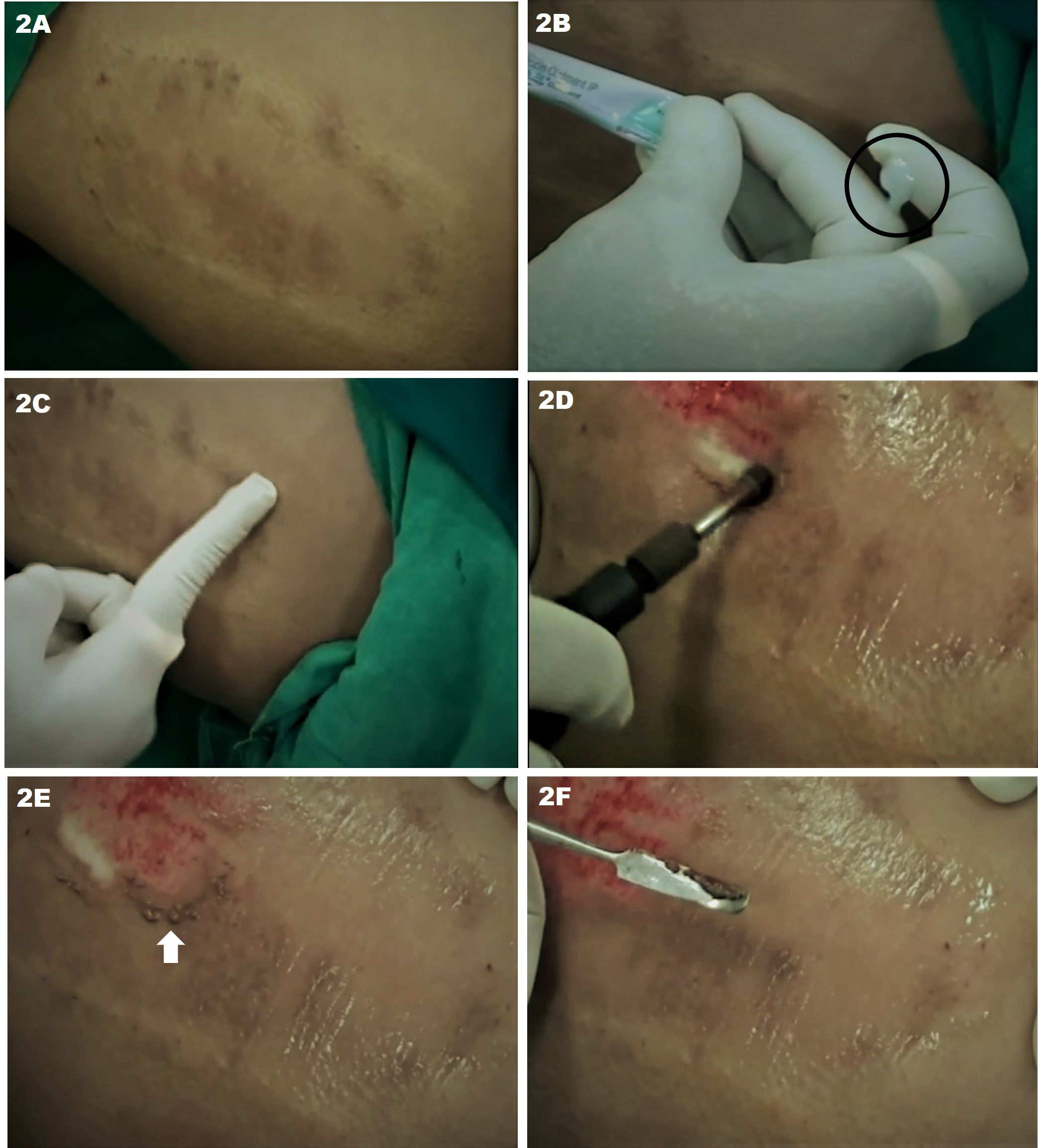 Figure 2. JODHPUR TECHNIQUE - Harvesting the graft from the donor site. (A) Baseline clinical image of the donor site, a post-STSG repigmented area with uneven texture (often encountered after STSG). This also shows the advantage of JT, in which a repigmented site can also be used as donor without the fear of depigmentation; (B) Antibiotic ointment (black circle shows the ointment blob to be smeared)  that would entrap the dermabraded particles from the donor site; (C) Pre-dermabrasion smearing of the ointment; (D) Dermabrasion of the ointment-smeared donor area to procure the graft; (E) The graft material visible as clumped particles along the periphery of the dermabraded donor area (white arrow); (F) Graft material collected using a spatula.