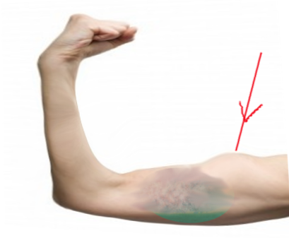 Biceps tendon rupture