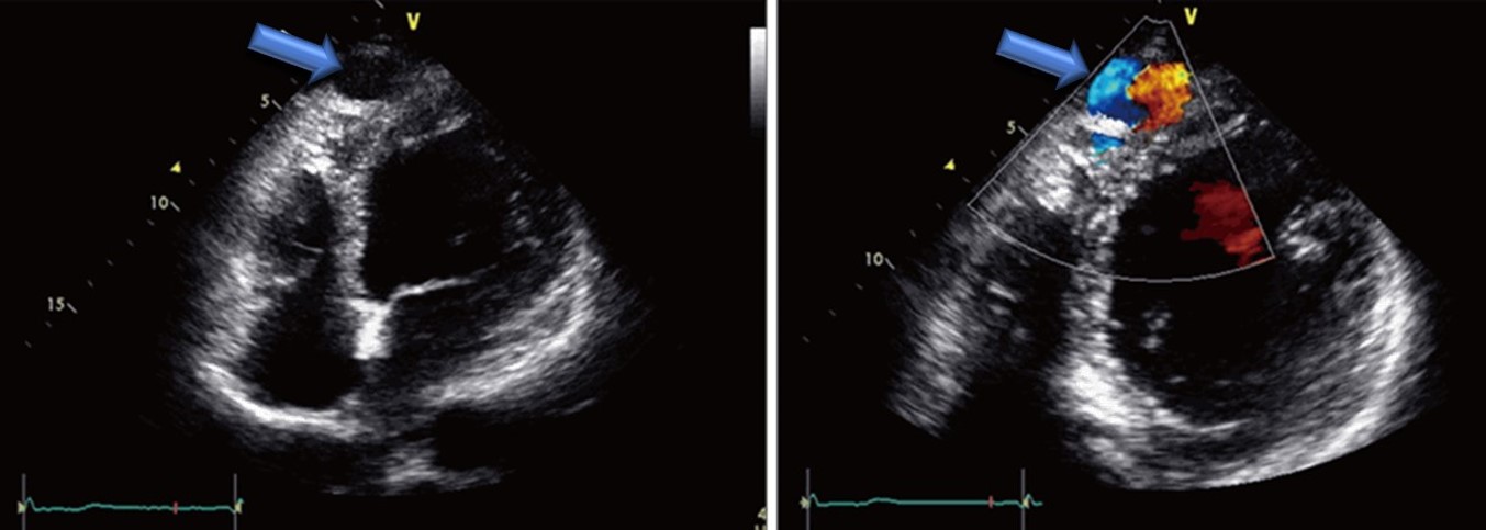 cardiac ultrasound of a coronary cameral fistula draining into the left ventricle in an adult