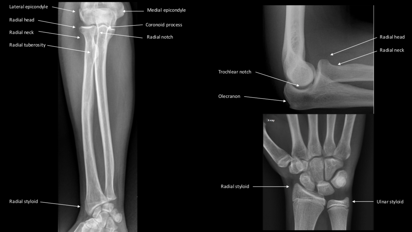 Left image shows an AP radiograph of the forearm. Upper right image is a lateral view of the elbow. Lower right is an AP radiograph of the wrist.