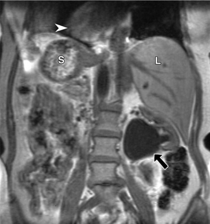 <p>Situs Inversus in a 56-year-old Woman With Left Flank Pain