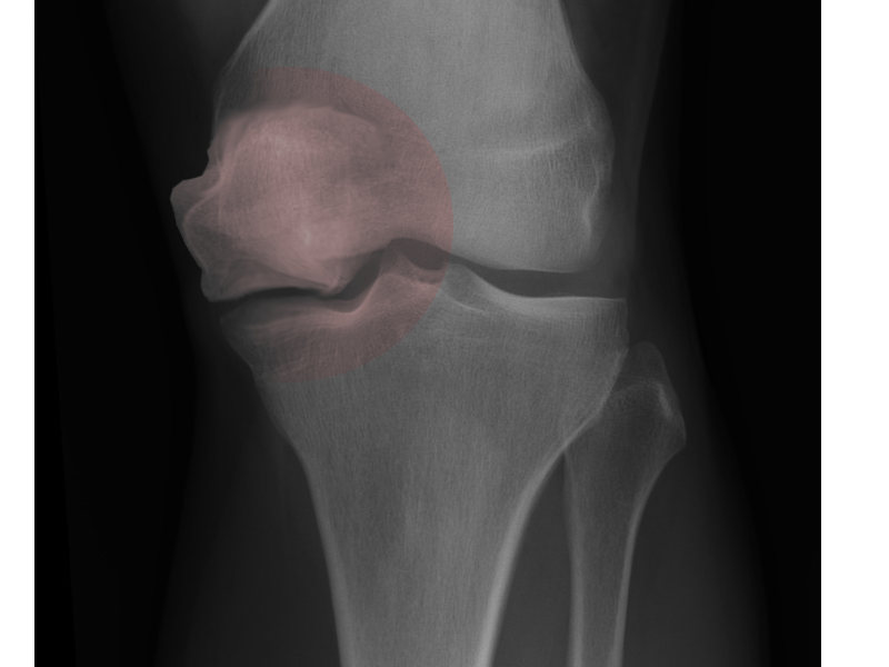 <p>Osteonecrosis of the knee</p>