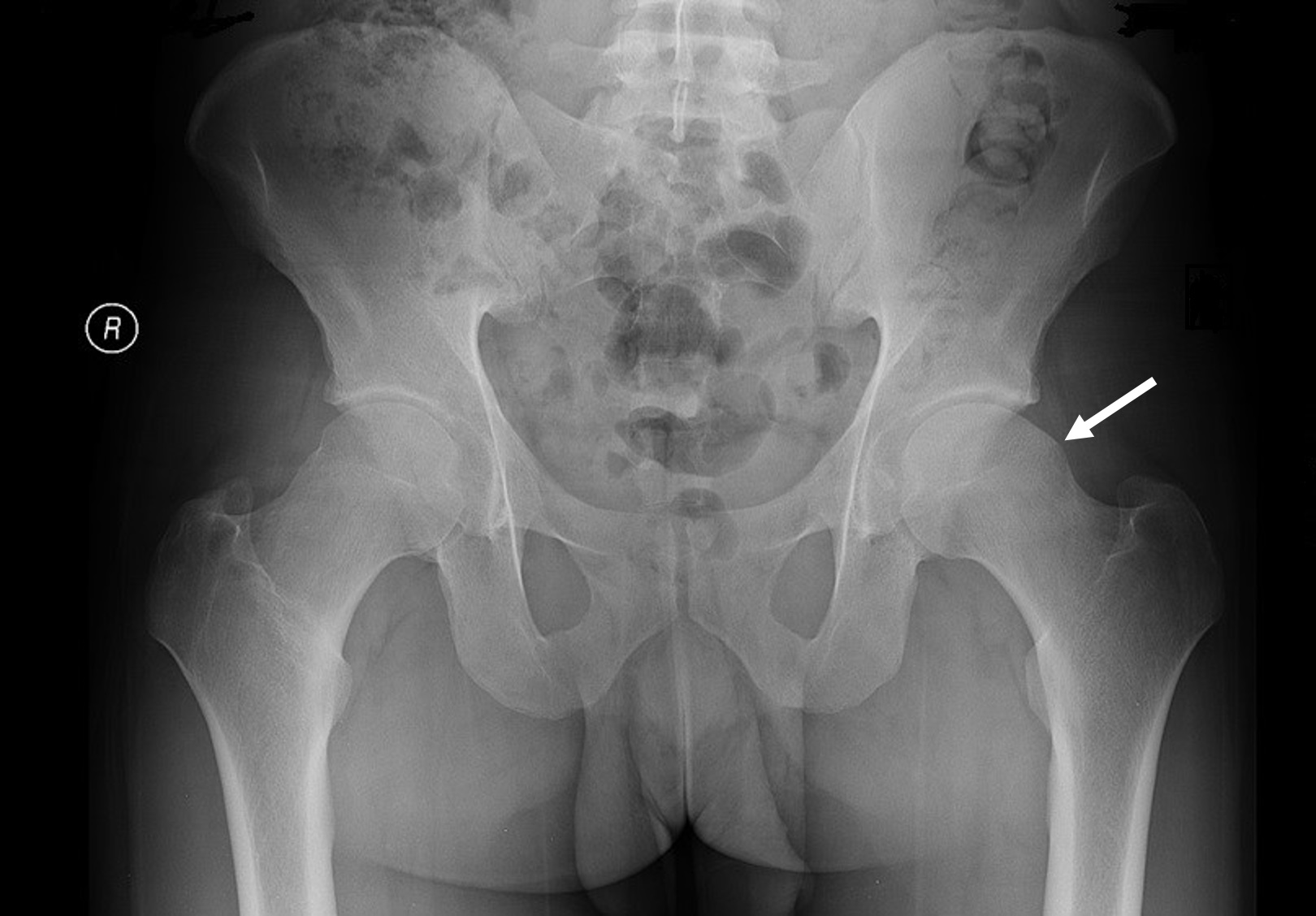 AP pelvis x-ray demonstrating a left hip cam lesion (indicated by white arrow) causing femoroacetabular impingement in this patient. Previous right hip cam lesion was treated with femoral osteoplasty.