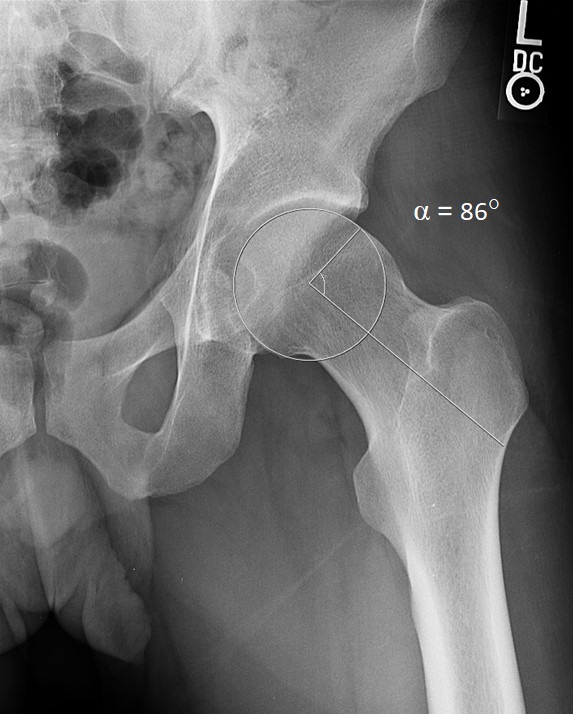 Dunn view of the left hip showing cam lesion and measured alpha angle of 86 degrees in a patient with femoroacetabular impingement.