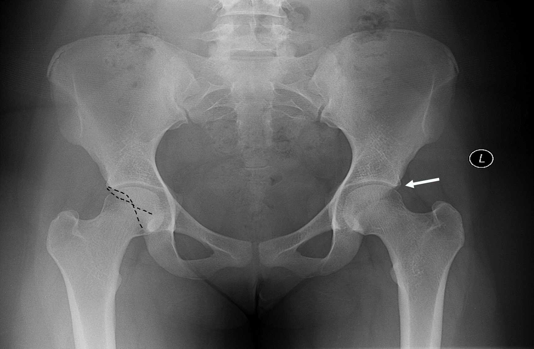 Pelvis x-ray demonstrating a pincer lesion of the left hip (indicated by white arrow). Right hip has dashed lines outlining the anterior and posterior walls of the acetabulum demonstrating a crossover sign indicative of a retroverted acetabulum.