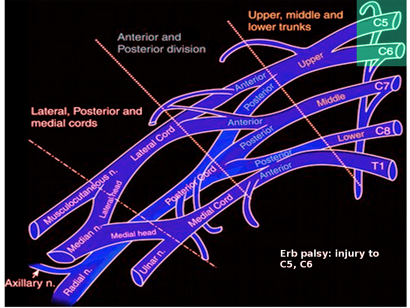 Erb palsy-brachial plexus