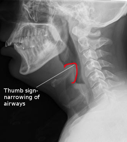 Lateral X-ray epiglottitis