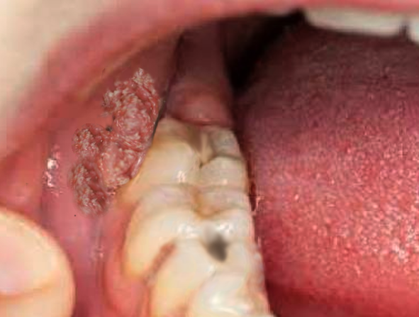 Oral condylomata