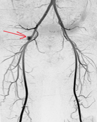 Femoral artery aneurysm