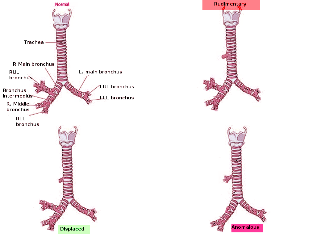 Types of tracheal bronchus