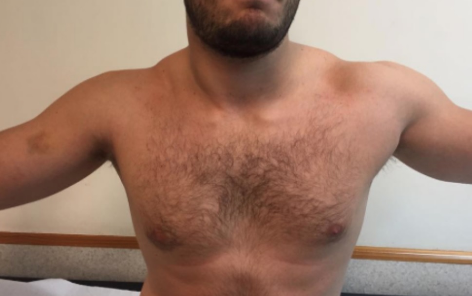 Clinical image showing a patient with a right Pectoralis major tear. 
Findings: Swelling and ecchymosis over the anterior arm. Asymmetric medial prominence of the muscle belly. Right nipple is lower.