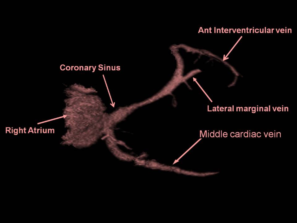 3D volume-rendered computed tomographic reconstruction of the coronary venous system.
