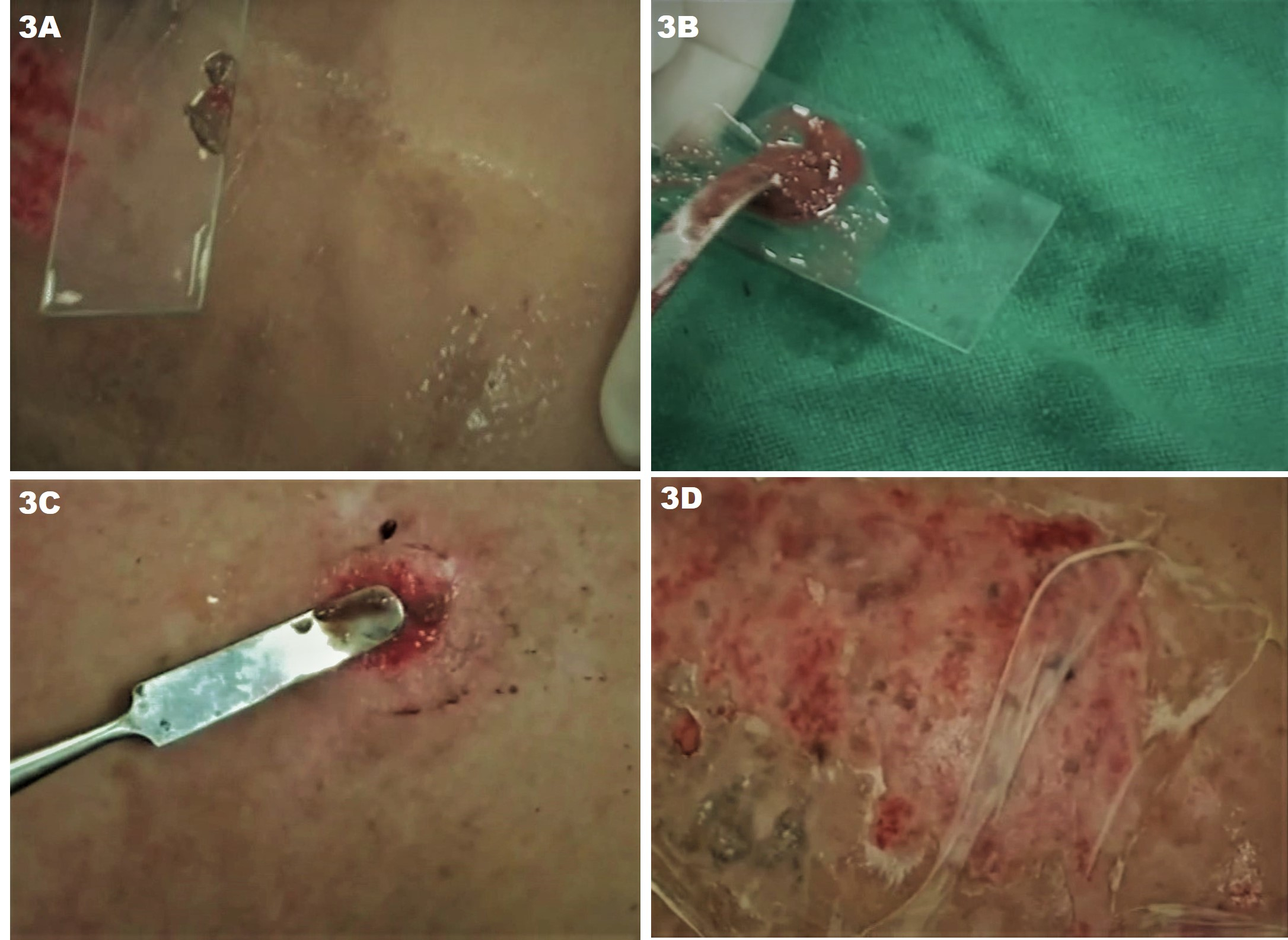 Figure 3. JODHPUR TECHNIQUE (JT) - Depiction of homogenizing the harvested graft and securing it evenly over the dermabraded recipient site. (A) Graft transferred to a slide and mixed with saline to form a homogenous paste; (B) Final material after mixing with saline ready to be grafted; (C) Simple technique of spreading the graft evenly; and (D) Collagen dressing placed over the recipient area after ensuring even and complete application of the graft-paste.