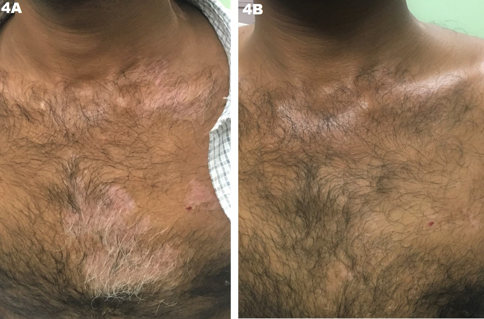 Figure 4. JODHPUR TECHNIQUE (JT) – Depiction of success of the technique in vitiligo. (A) Baseline vitiligo lesions over the chest of a middle-aged man. These lesions failed to repigment despite prolonged medical and phototherapy, possibly due to visible leucotrichia; and (B) More than 90% area with almost near-complete repigmentation and excellent color match with the normal skin, after a single session of JT and 4 weeks of NB-UVB phototherapy. Note the disappearance of leucotrichia, a good prognostic phenomenon seen rarely with any other surgical procedure for vitiligo. 