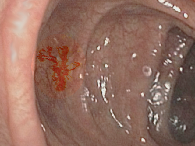 Angiodysplasia of colon
