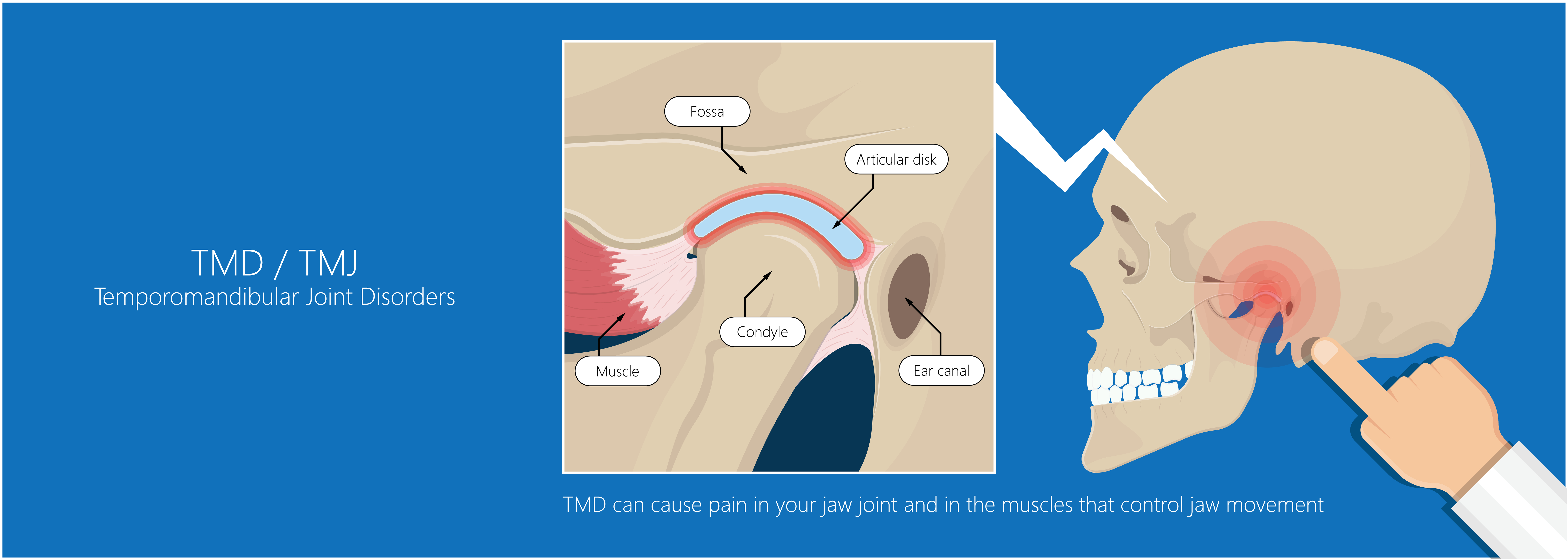 Temporomandibular joint disorder