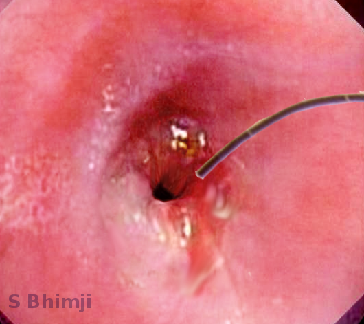 Malignant esophageal stricture