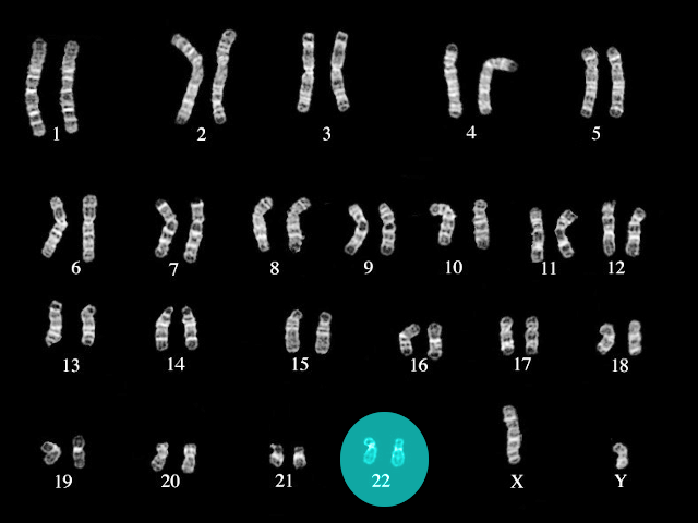 DiGeorge syndrome karyotype
