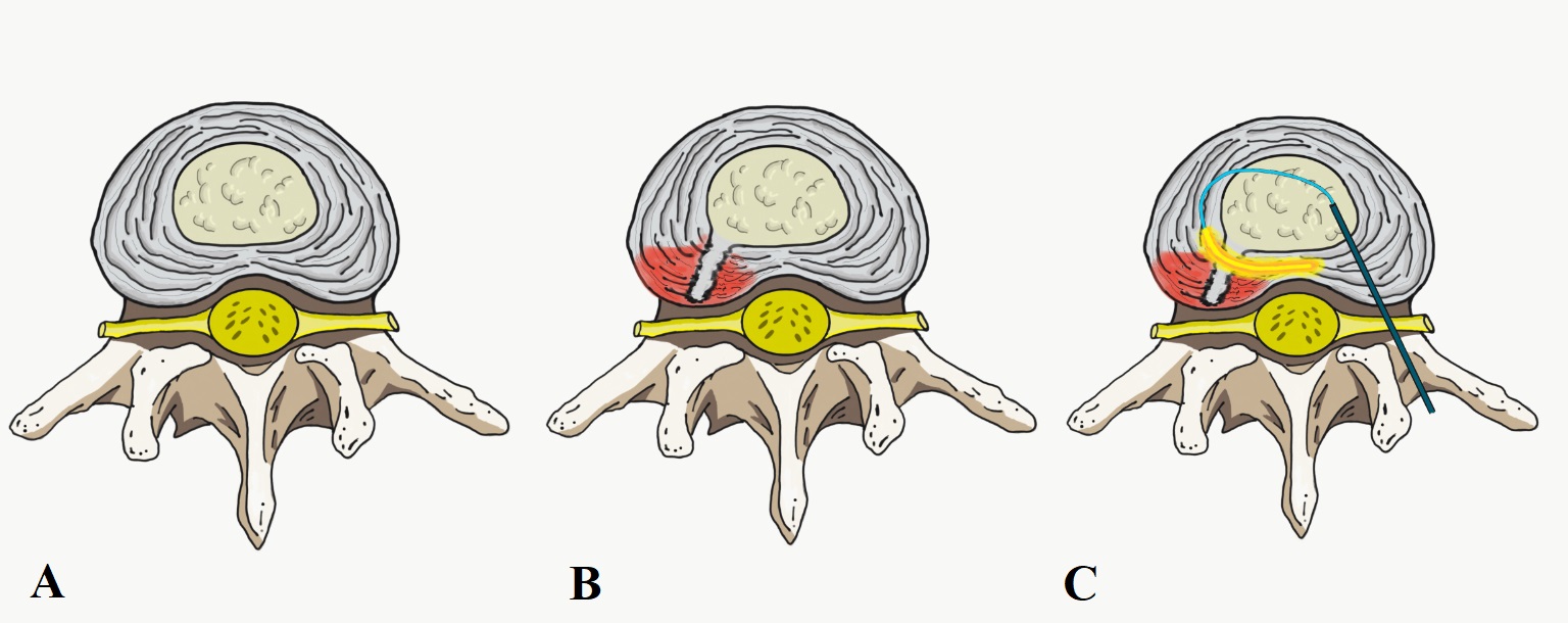 Figure 1. A) Normal intervertebral disc; B) Posterolateral annular tear; C) IDET procedure