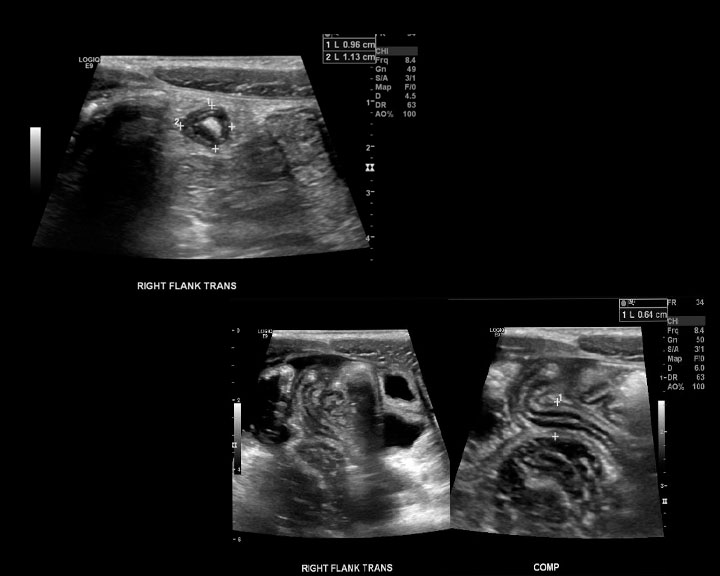 Ultrasound of the right lower quadrant with findings of acute appendicitis.  There is a blind ending tubular structure measuring up to 7 mm in diameter.  