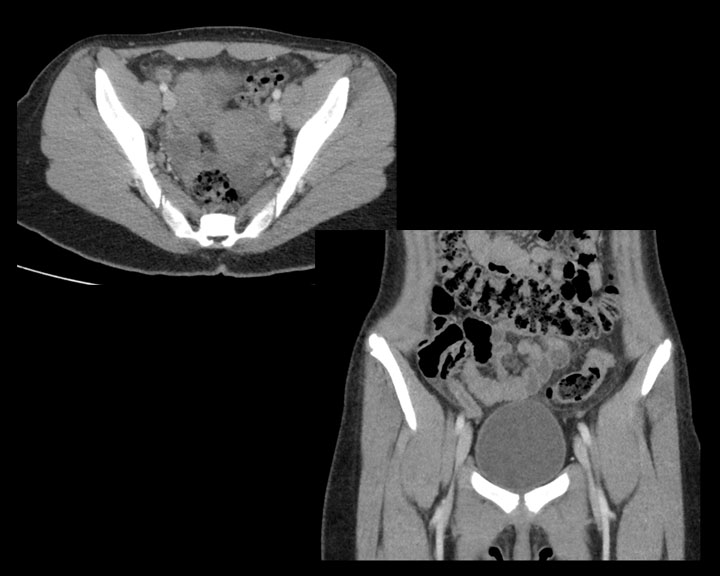 CT of early acute appendicitis.  In the right lower quadrant there is a mildly dilated appendix that is filled with fluid having adjacent fat stranding.  