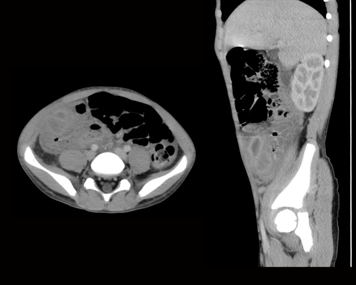 There is acute appendicitis with a dilated fluid filled tubular structure in the right lower quadrant on this axial and sagittal images with a surrounding fluid collection and stranding due to developing abscess.  