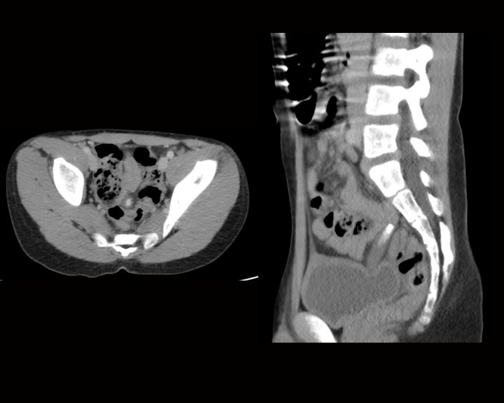 Early acute appendicitis with the dilated fluid filled appendix containing an appendicolith, the appendix is sitting on the urinary bladder.  