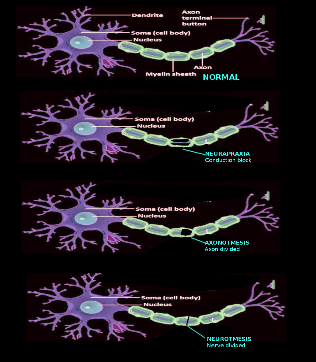 Types of nerve injury