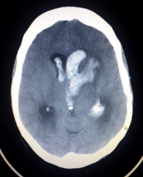 Intracerebral hemorrhage with intraventricular bleed