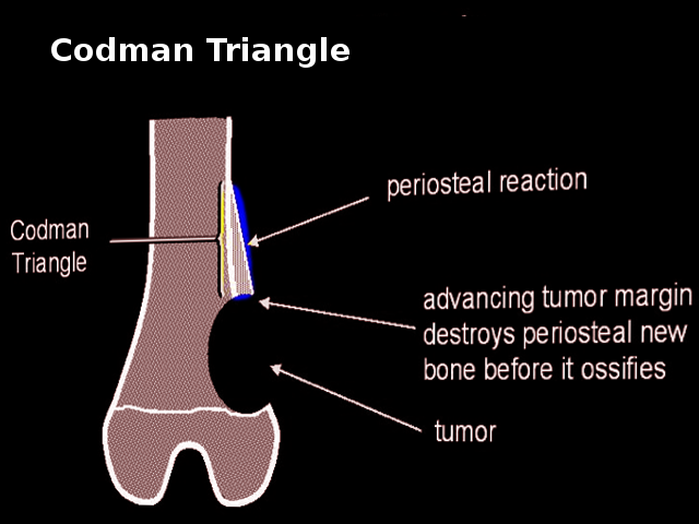 Codman triangle
