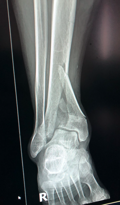 Distal Tibia Pilon fracture