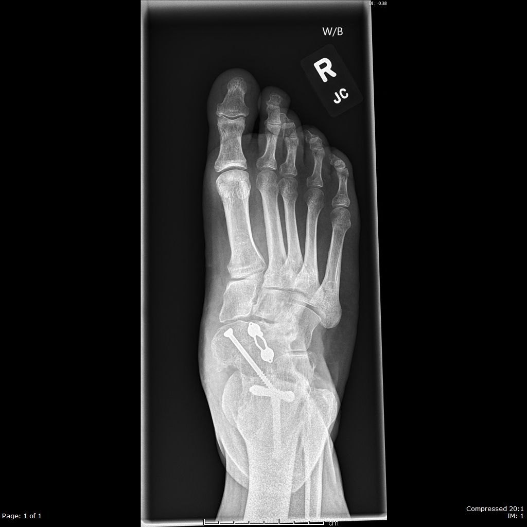 Dorsal-plantar radiograph demonstrating double arthrodesis for residual clubfoot deformity with pain and bone/joint deformity