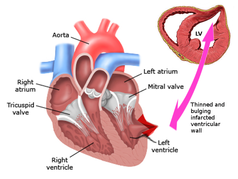 Left ventricular pseudoaneurysm