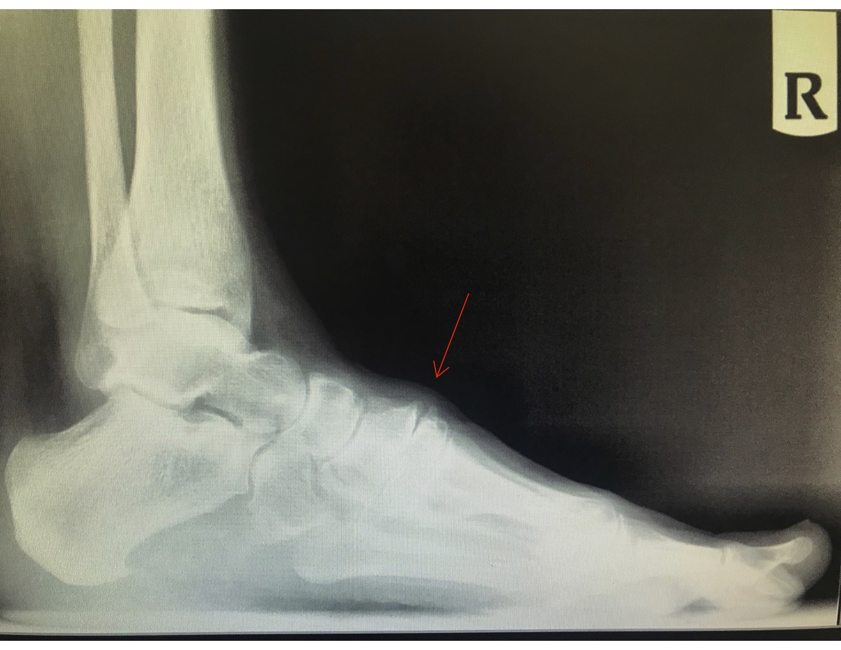 Anterior Tarsal Tunnel Syndrome- Note the dorsal soft tissue swelling and dorsal osteophyte from the metatarsal-cuneiform joint causing distal paresthesias due to medical dorsal cutaneous nerve entrapment. 