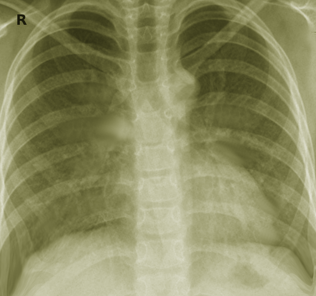<p>Chest X-ray of Mycobacterium Avium-Intracellulare Pneumonia.</p>
