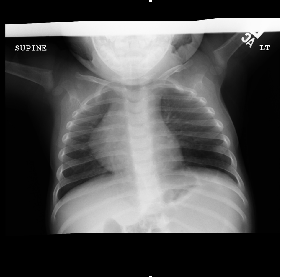 AP view of chest radiograph showing left lower lobe CPAM 