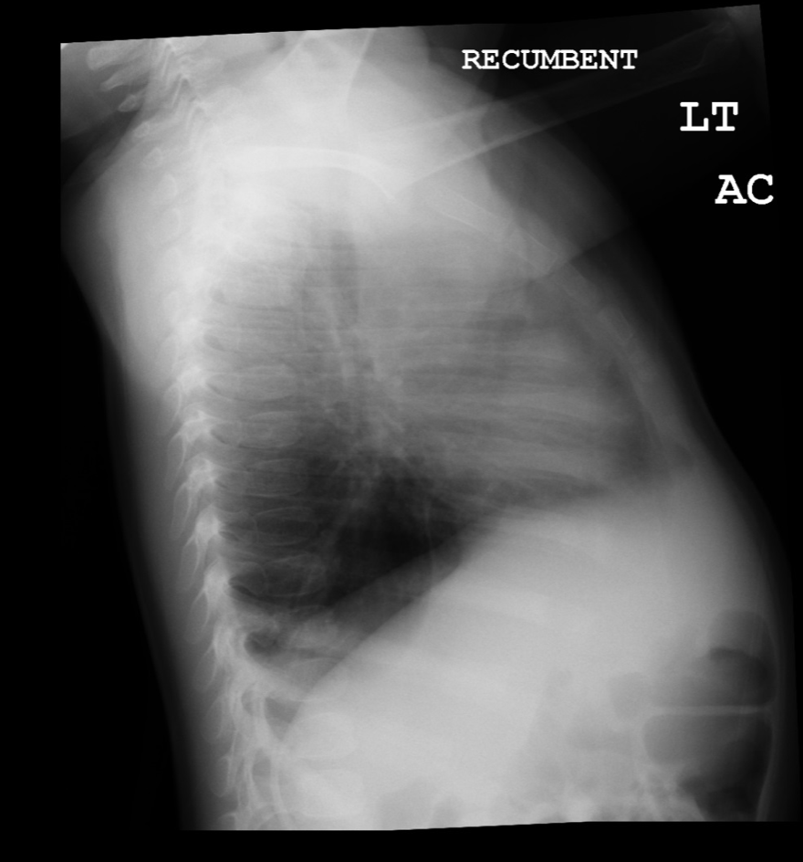 Lateral view of chest radiograph showing left lower lobe CPAM 