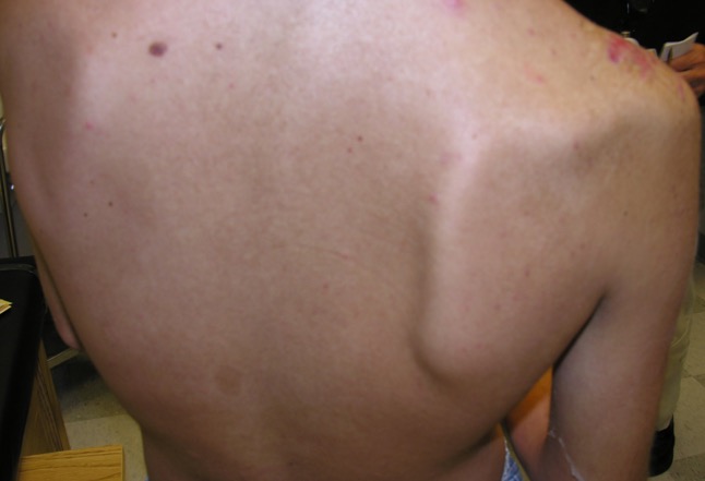 Right shoulder medial scapular winging secondary to long thoracic nerve palsy associated with brachial plexus injury