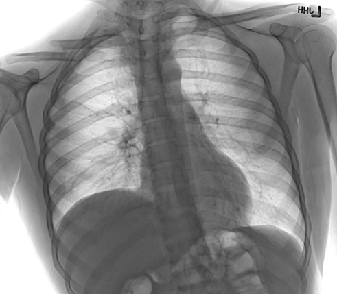 CXR demonstrating right clavicle fracture, elevated right hemi-diaphragm associated with phrenic nerve injury